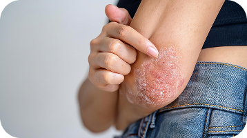 A woman's arm with atopic dermatitis