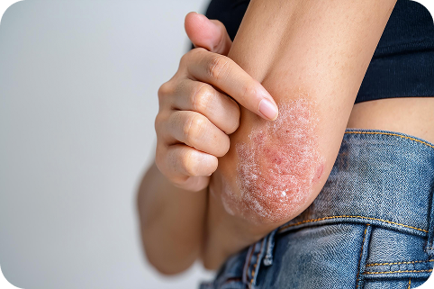 A woman's arm with atopic dermatitis